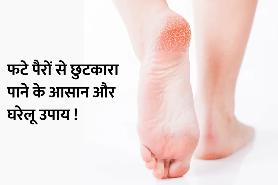 Get rid of cracked feet